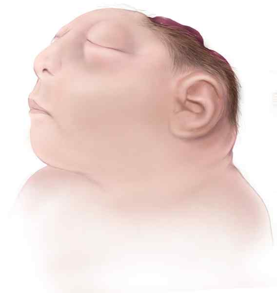 Perbezaan antara Acrania dan Anencephaly