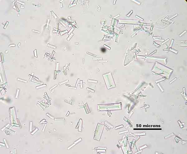 Unterschied zwischen amorphem Urat und Phosphat