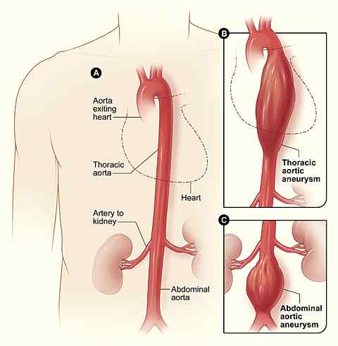 Perbezaan antara aneurisme dan bekuan darah