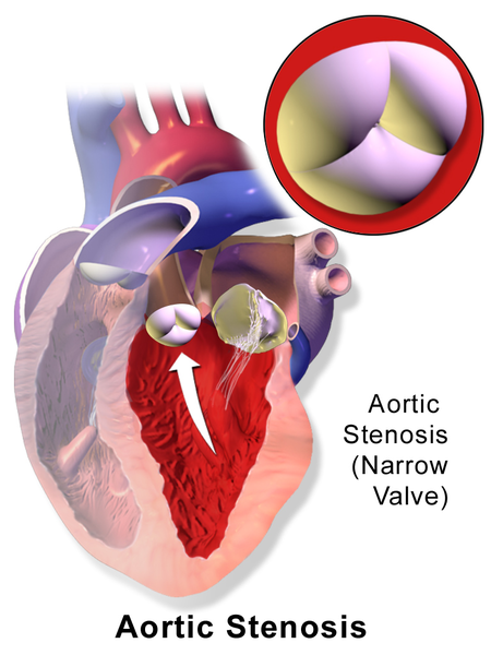 Perbedaan antara stenosis aorta dan koarktasi aorta