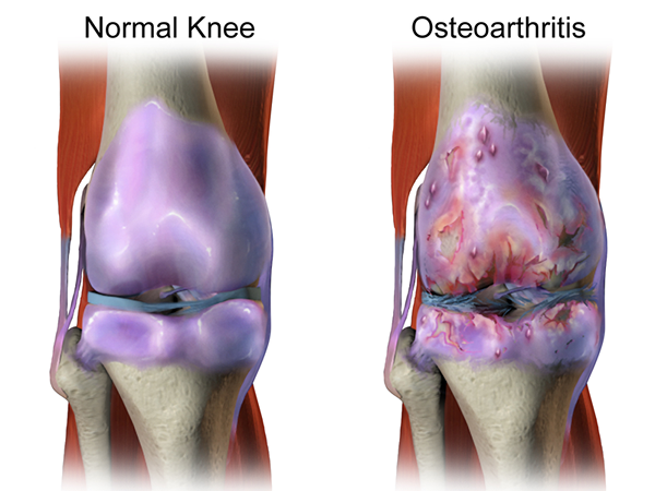 Perbedaan antara radang sendi dan osteoartritis