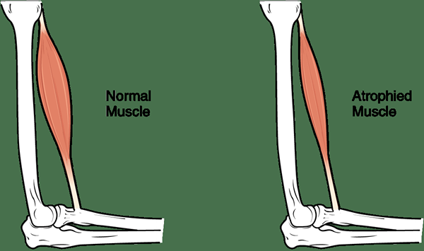 Différence entre atrophie et dystrophie