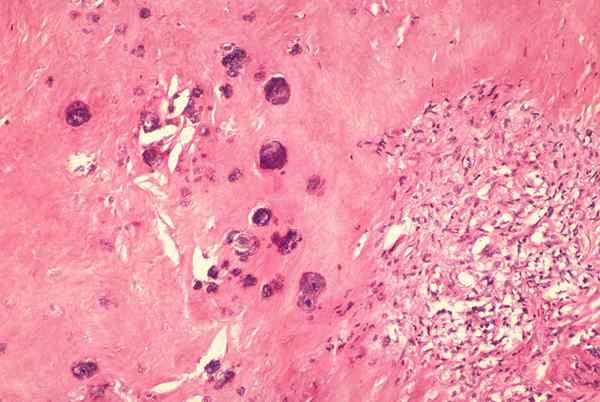 Différence entre la calcification dystrophique et métastatique