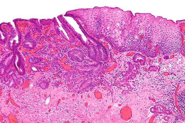 Différence entre l'épithélium œsophagien et gastrique