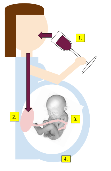 Diferencia entre el síndrome de alcohol fetal y los efectos de alcohol fetal