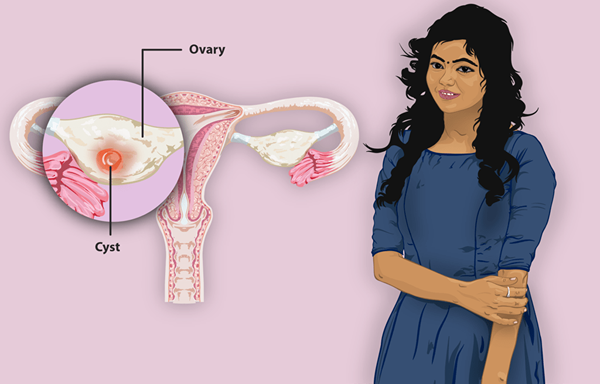 Diferencia entre el quiste fibroide y ovárico