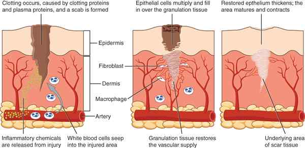 Différence entre le tissu de granulation et le granulome