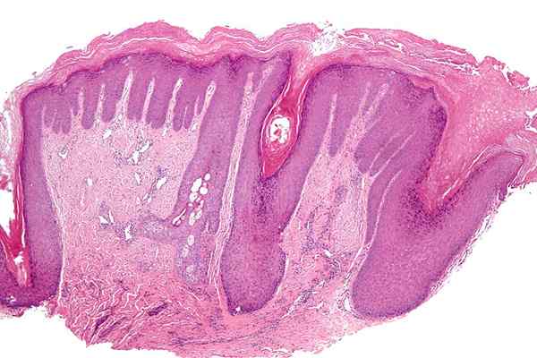 Perbedaan antara hiperkeratosis dan parakeratosis