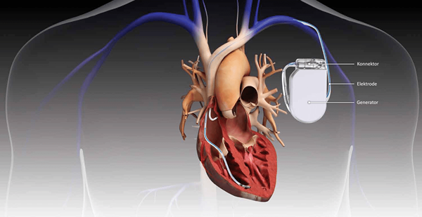 Unterschied zwischen ICD und Herzschrittmacher