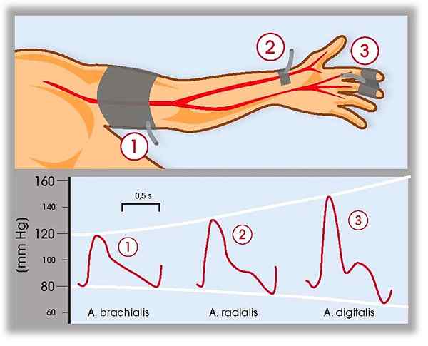 Diferencia entre la presión arterial invasiva y no invasiva