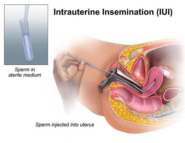 Diferencia entre IUI e ICI