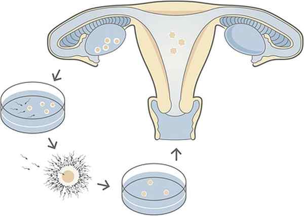 Perbezaan antara IVF dan surrogacy