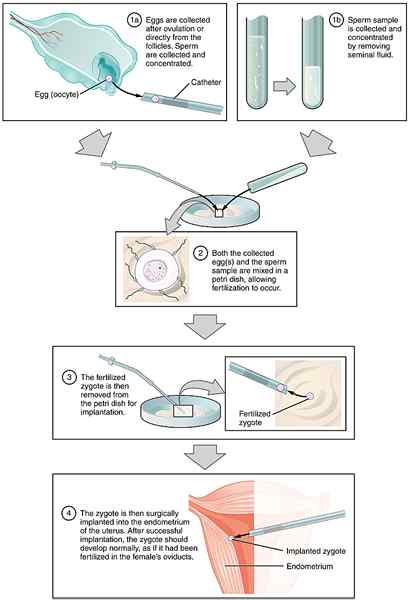 Perbezaan antara hadiah IVF dan zift