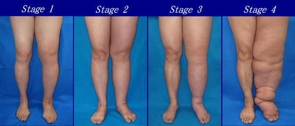 Diferencia entre el lipedema y el linfedema