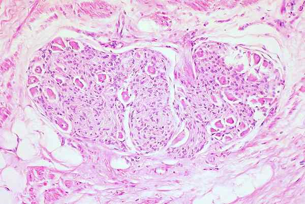 Perbezaan antara teratoma matang dan tidak matang