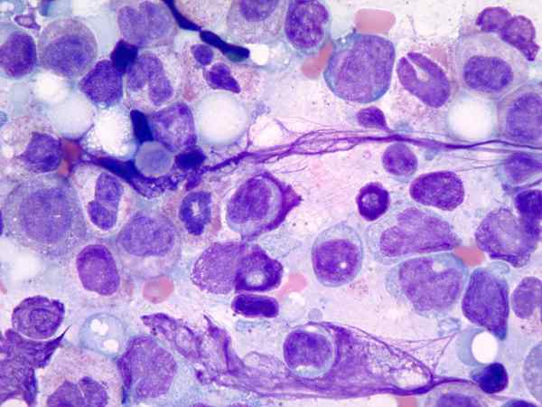 Différence entre les MD et la leucémie