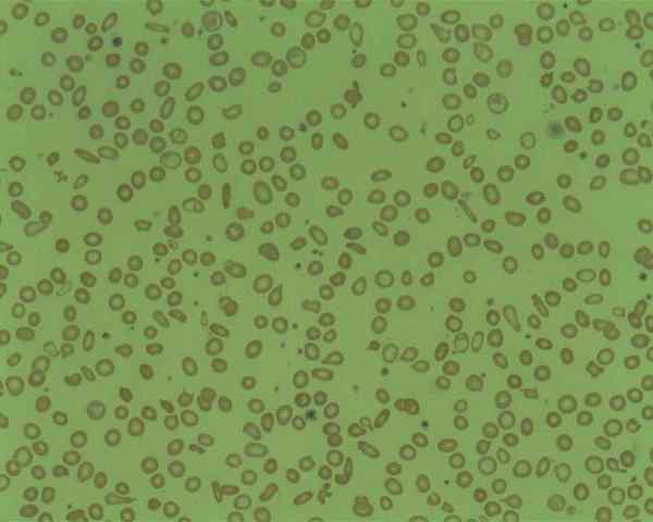 Différence entre l'anémie microcytaire et macrocytaire