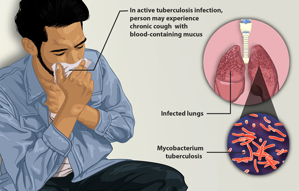 Différence entre Mycobacterium tuberculosis et Mycobacteria non tuberculeuse