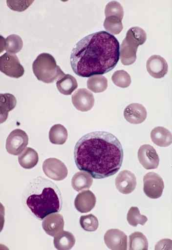 Différence entre le myéloblaste et le lymphoblaste