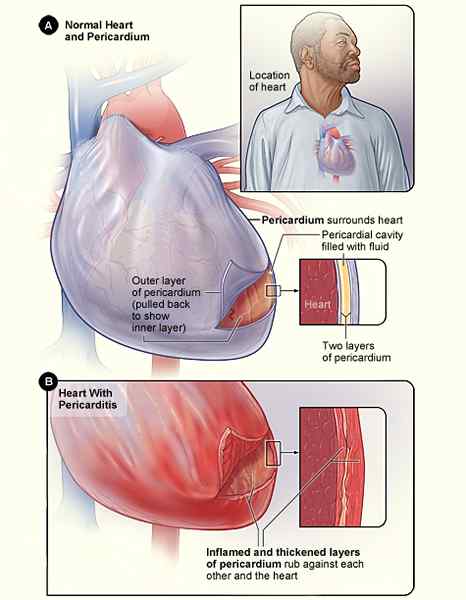 Diferencia entre la miocarditis y la pericarditis