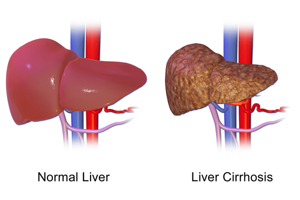 Unterschied zwischen NAFLD und Nash