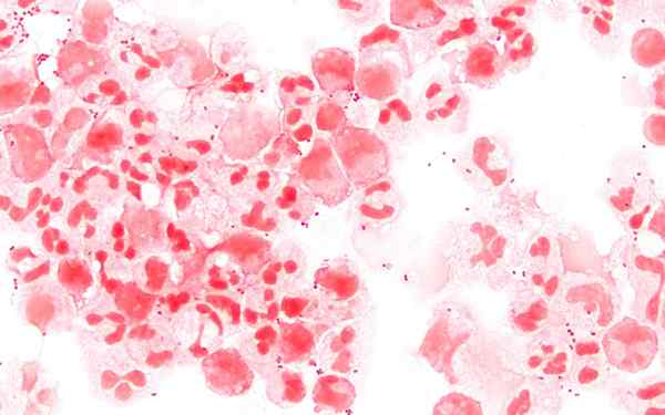Perbezaan antara Neisseria Gonorrhoeae dan Neisseria Meningitidis
