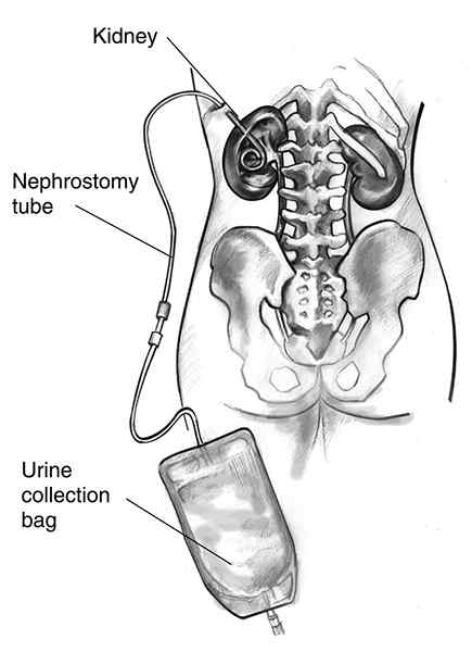 Différence entre néphrostomie et urostomie