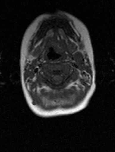 Diferencia entre el neuroblastoma y el meduloblastoma