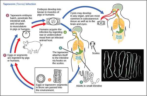 Diferencia entre Pinworm (Treveworm) y Tapeworm