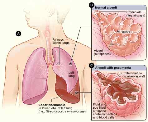 Perbezaan antara radang paru -paru dan pneumonia berjalan