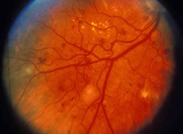Perbezaan antara retinopati proliferatif dan tidak proliferatif
