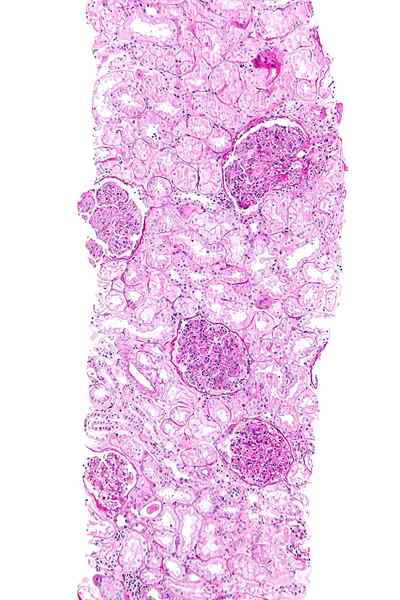 Perbezaan antara pyelonephritis dan glomerulonephritis