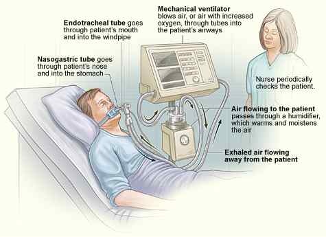 Perbezaan antara pernafasan dan ventilator