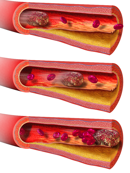Différence entre la thrombose et l'embolie