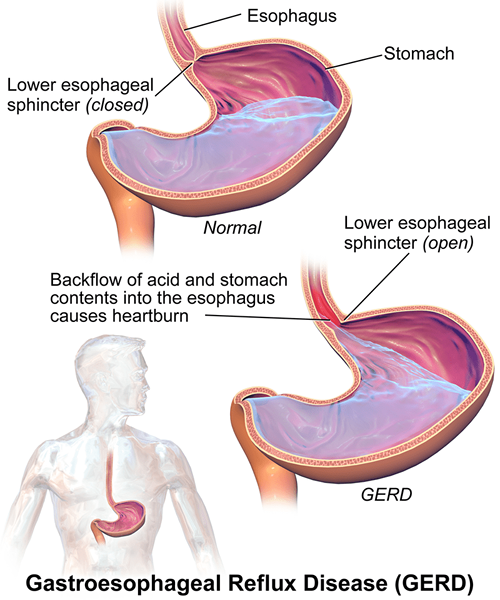 ¿Cuál es la diferencia entre achalasia y gerd?