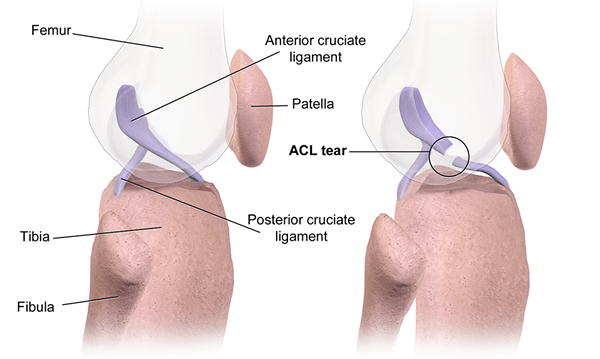 ¿Cuál es la diferencia entre ACL y la lágrima de menisco?