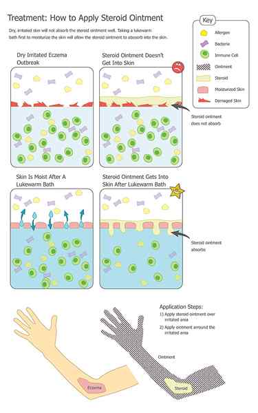 Quelle est la différence entre l'acné et l'eczéma