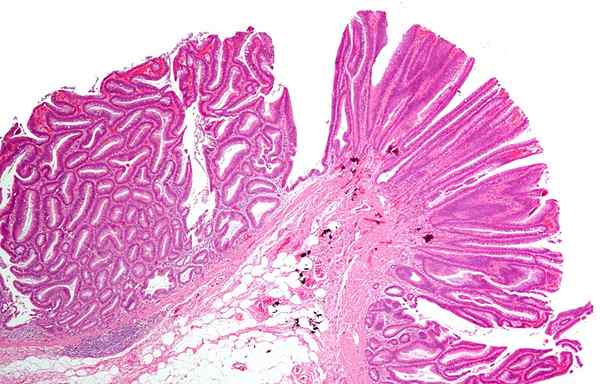 Was ist der Unterschied zwischen Adenom und Polyp