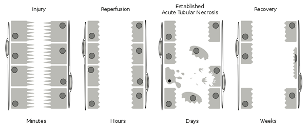 ¿Cuál es la diferencia entre AKD y CKD?