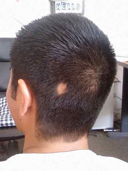 Apa perbedaan antara alopecia areata dan tinea capitis