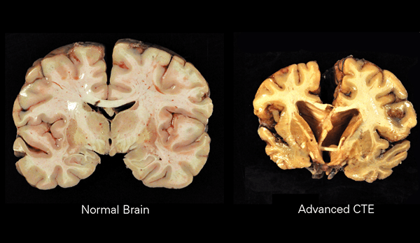 Was ist der Unterschied zwischen Alzheimer und CTE