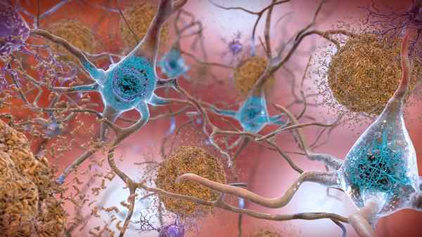 Apa perbedaan antara plak amiloid dan kusut neurofibrillary