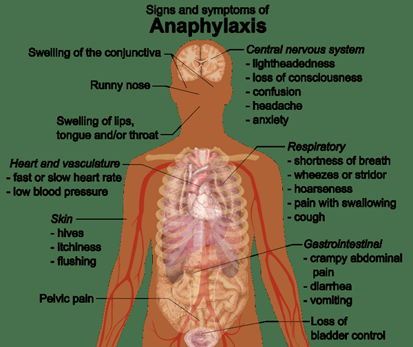 Quelle est la différence entre l'anaphylaxie et l'œdème de l'angio