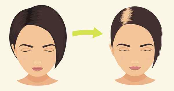 Was ist der Unterschied zwischen androgenetischen Alopezie und Telogen -Effluvium