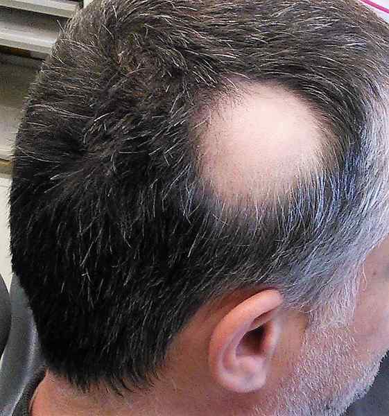 ¿Cuál es la diferencia entre la alopecia androgénica y la alopecia areata?