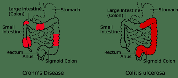 Was ist der Unterschied zwischen Blinddarmentzündung und Morbus Crohn