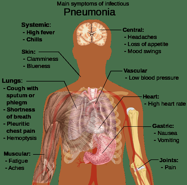 Quelle est la différence entre les ARD et la pneumonie