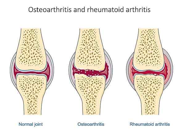 Quelle est la différence entre l'arthralgie et l'arthrite