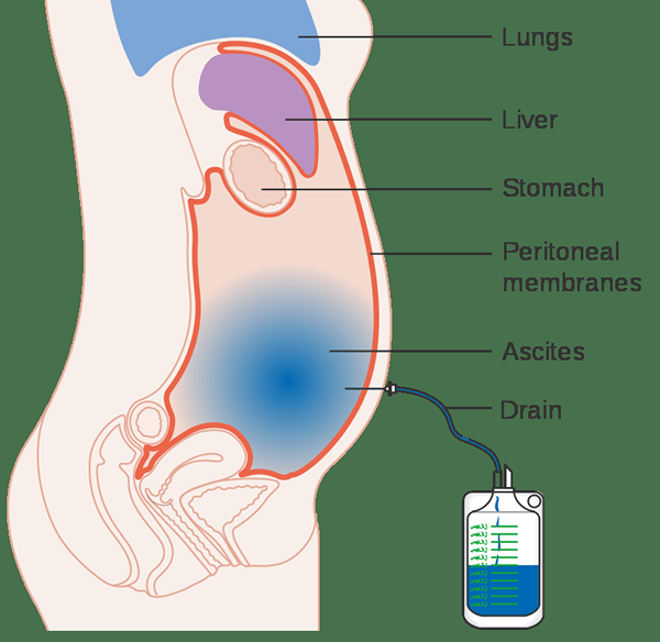 ¿Cuál es la diferencia entre ascitis y peritonitis?