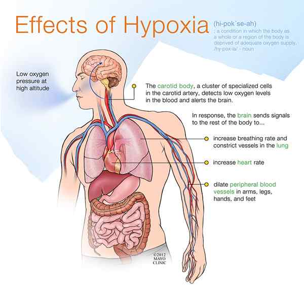 Was ist der Unterschied zwischen Asphyxie und Hypoxie